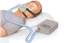 IFN - ¿Cómo se tratan las apneas obstructivas del sueño 